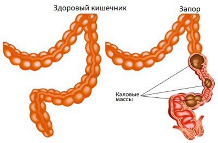 Лечение копростаза