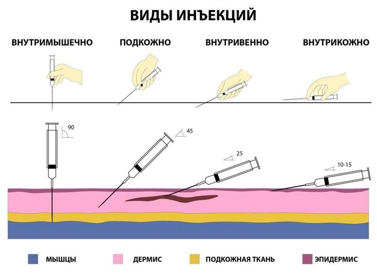 Выбор подходящего места для инъекции
